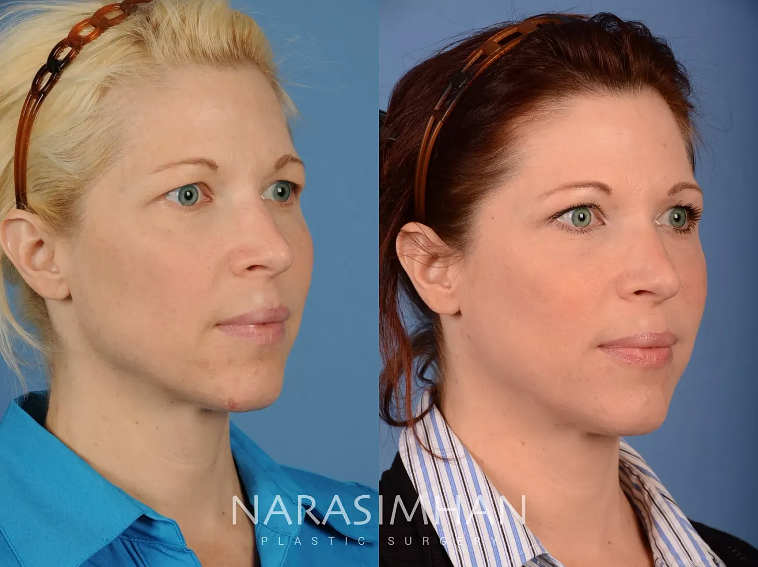 Facial Sculpting Before & After
