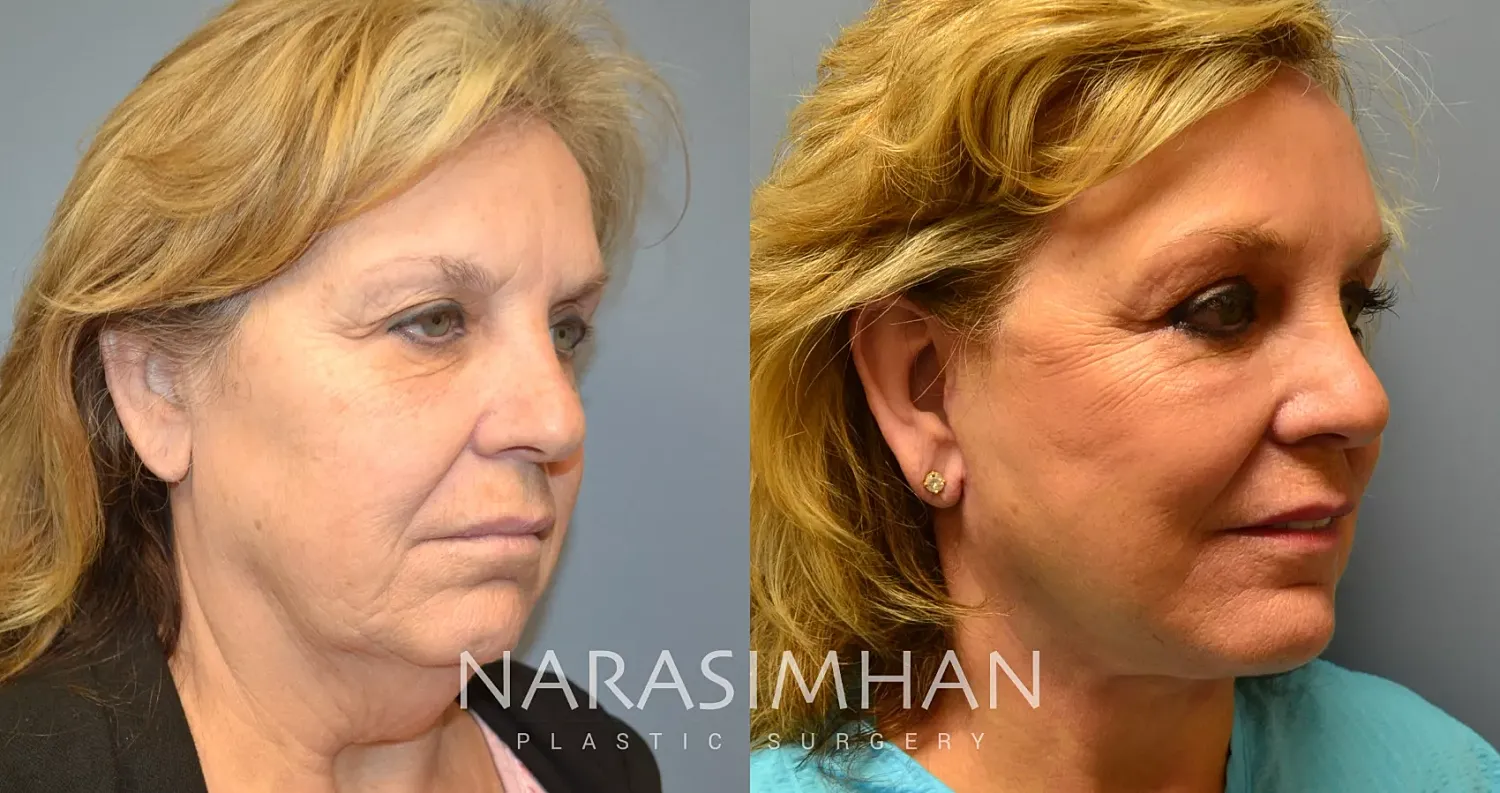 Facial Sculpting Before & After