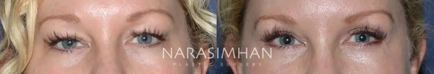 Facial Sculpting Before & After