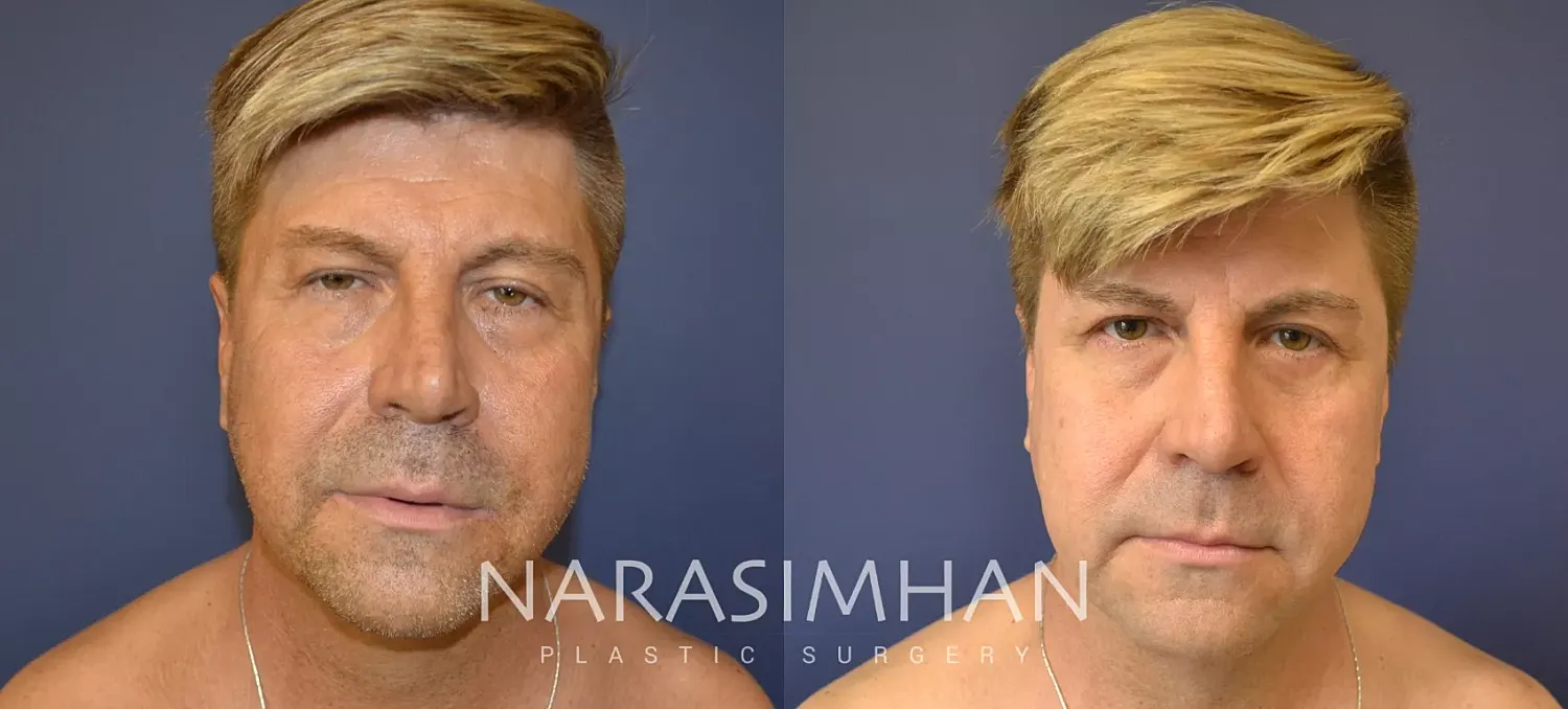 Facial Sculpting Before & After