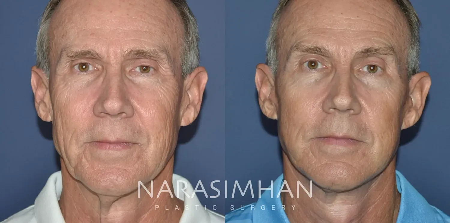 Facial Sculpting Before & After