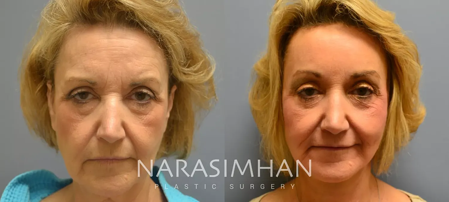Facial Sculpting Before & After