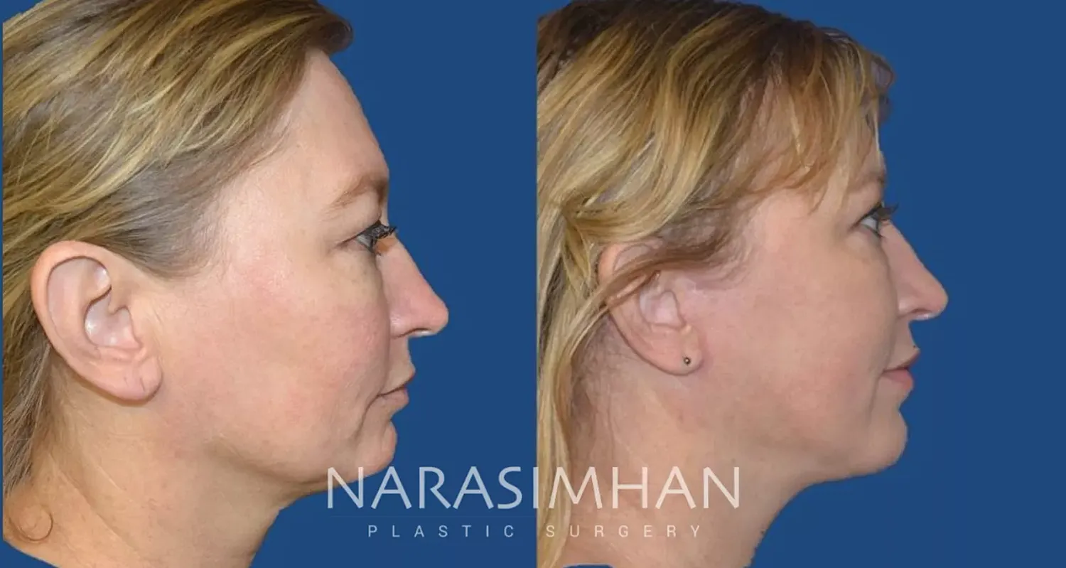 Facial Sculpting Before & After