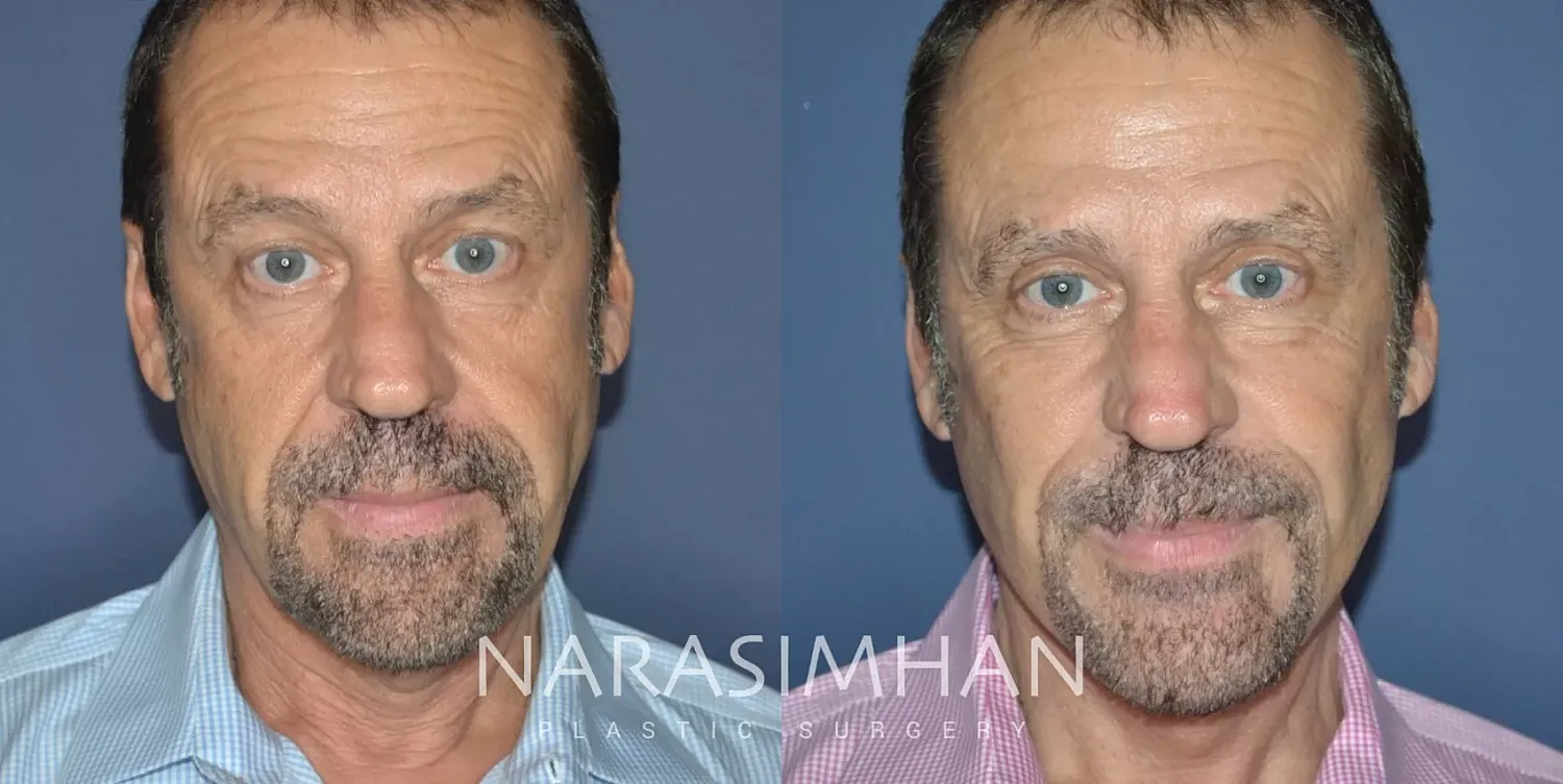 Facial Sculpting Before & After