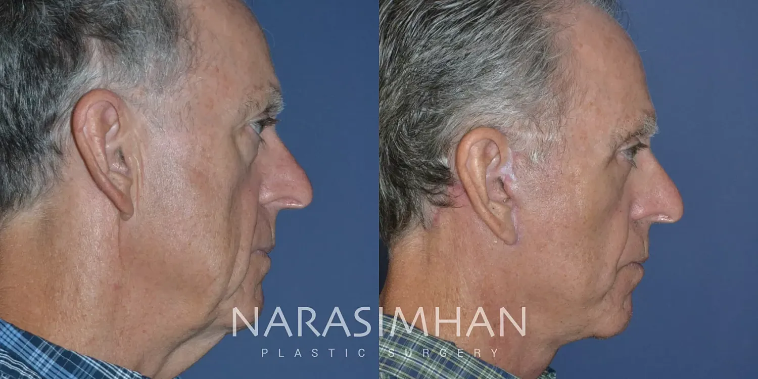 Facial Sculpting Before & After