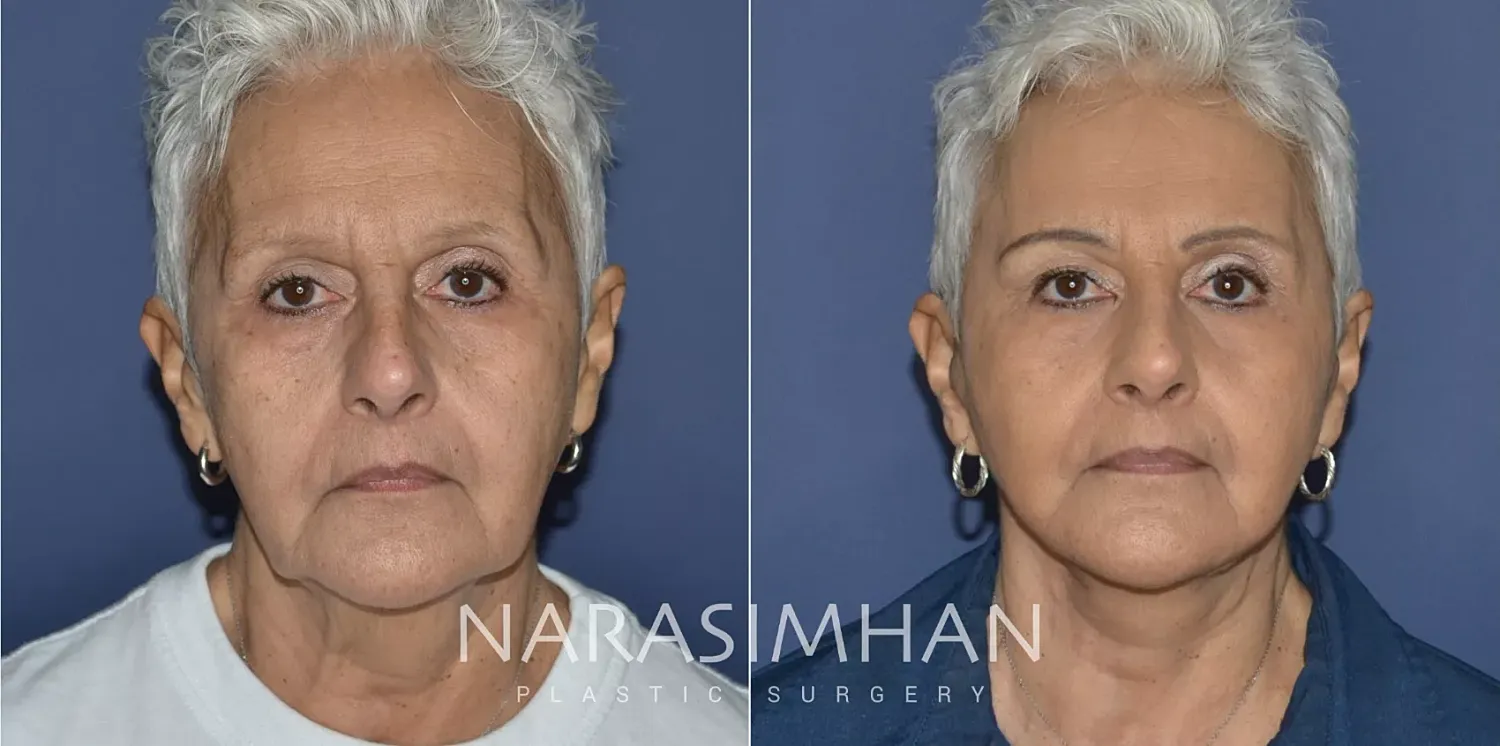 Facial Sculpting Before & After