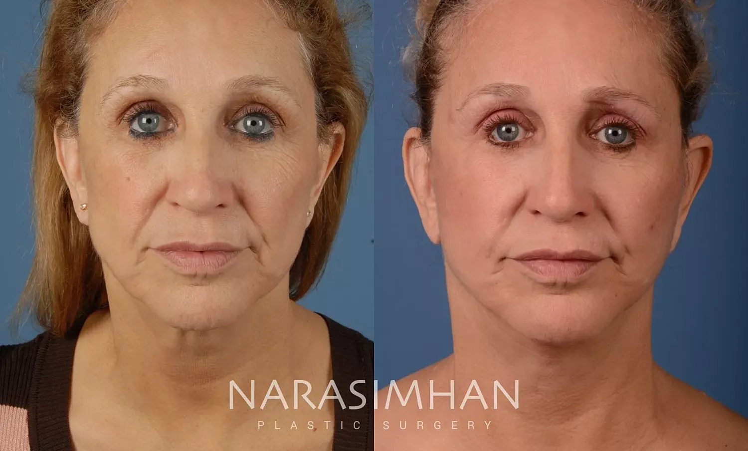 Facial Sculpting Before & After
