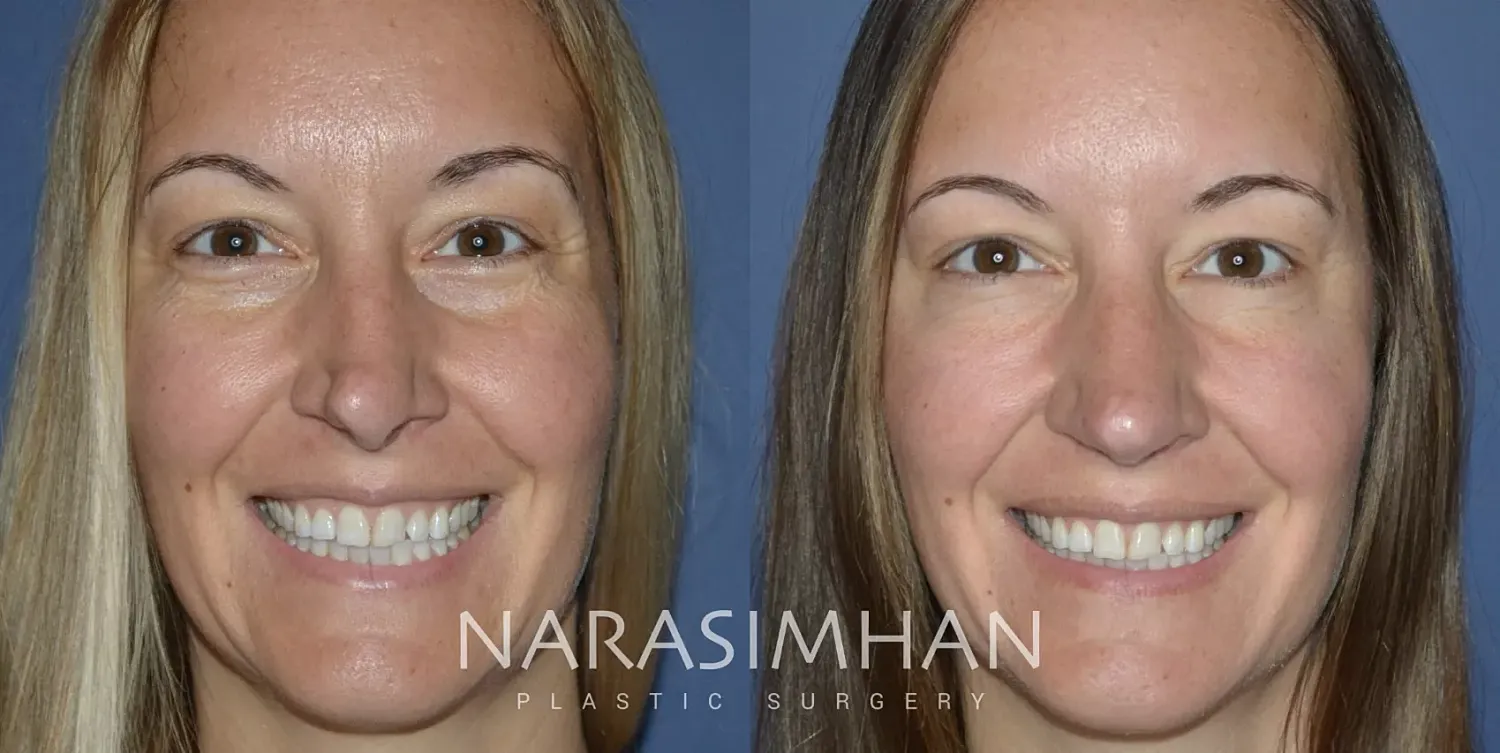 Facial Sculpting Before & After