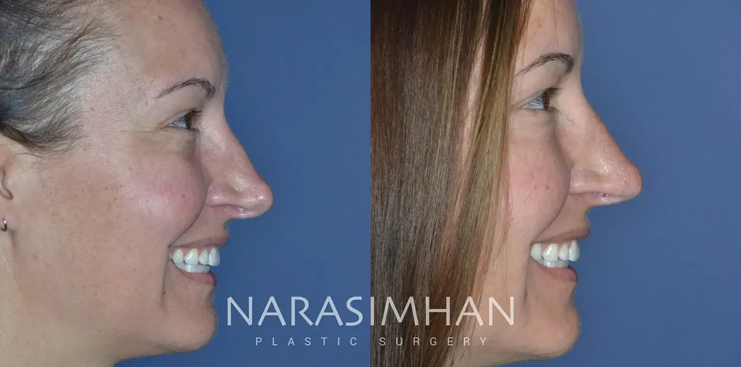 Facial Sculpting Before & After