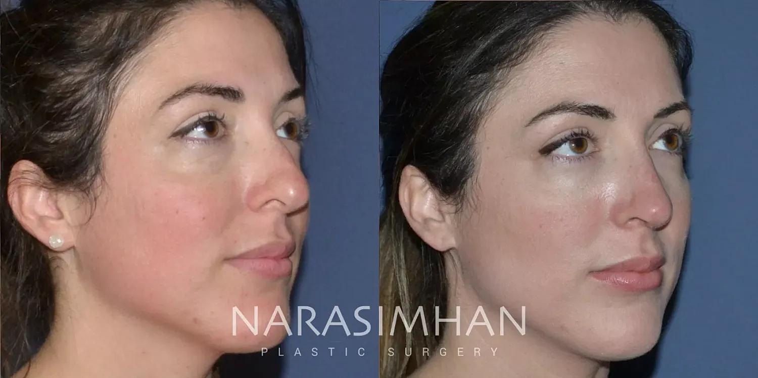 Facial Sculpting Before & After