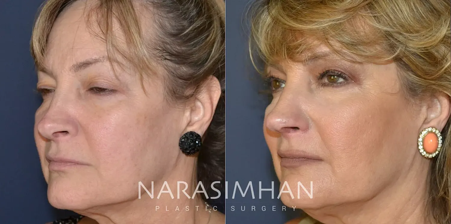 Facial Sculpting Before & After