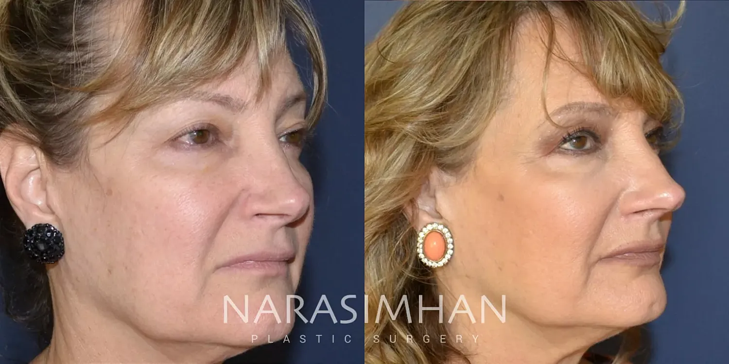 Facial Sculpting Before & After