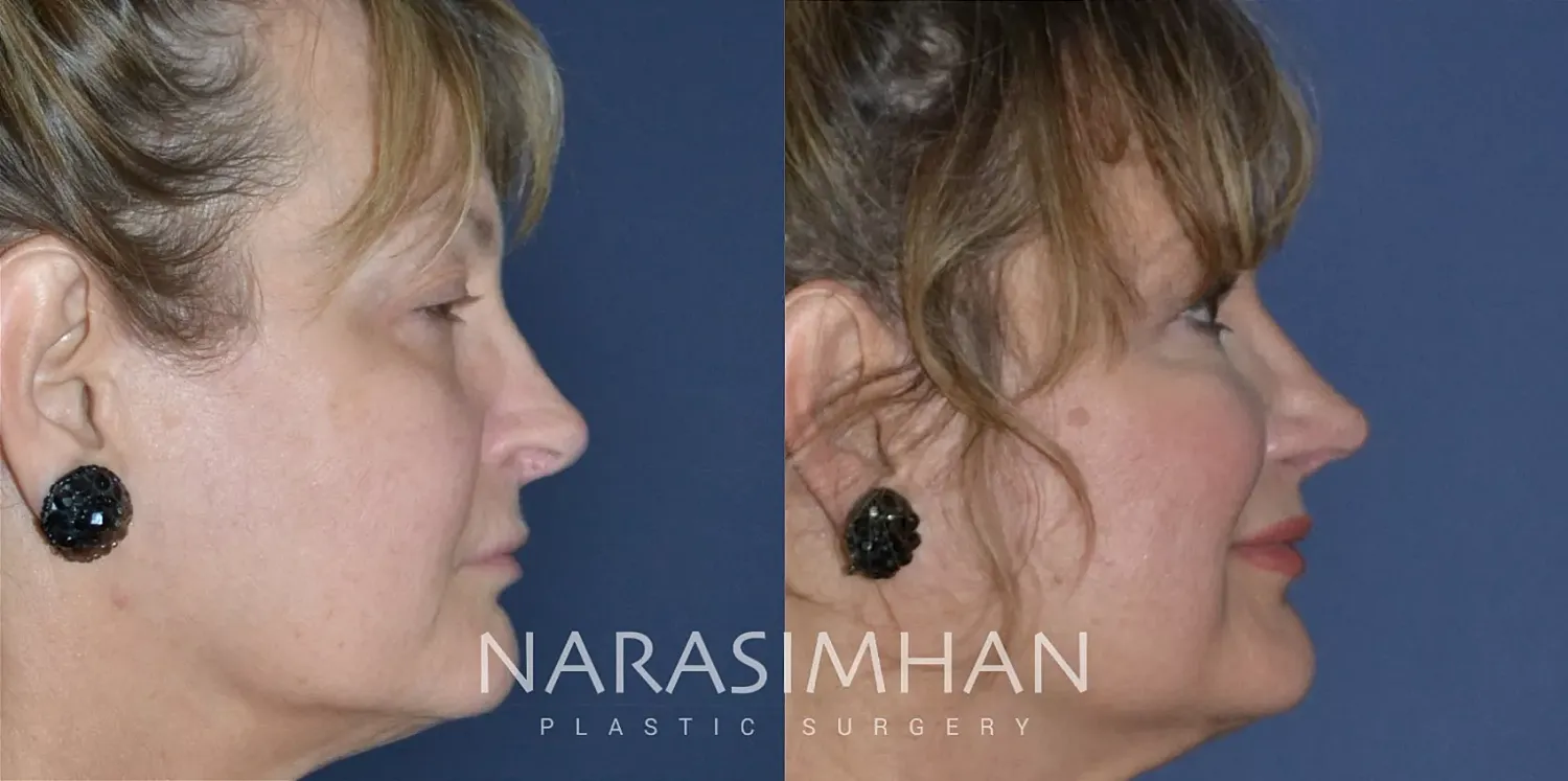 Facial Sculpting Before & After