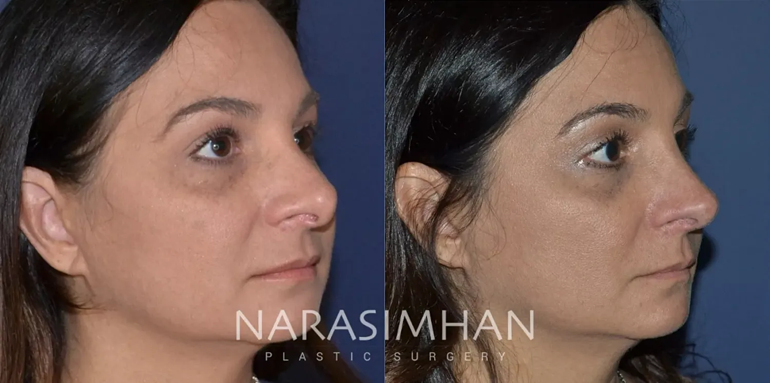 Facial Sculpting Before & After