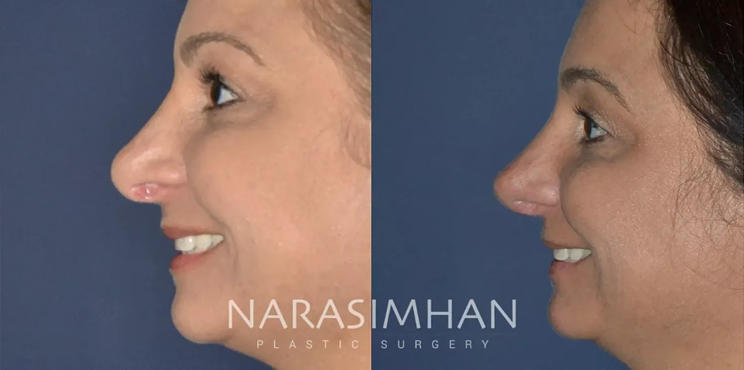 Facial Sculpting Before & After