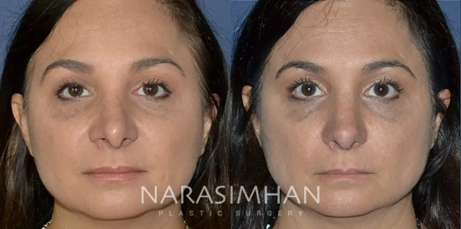 Facial Sculpting Before & After