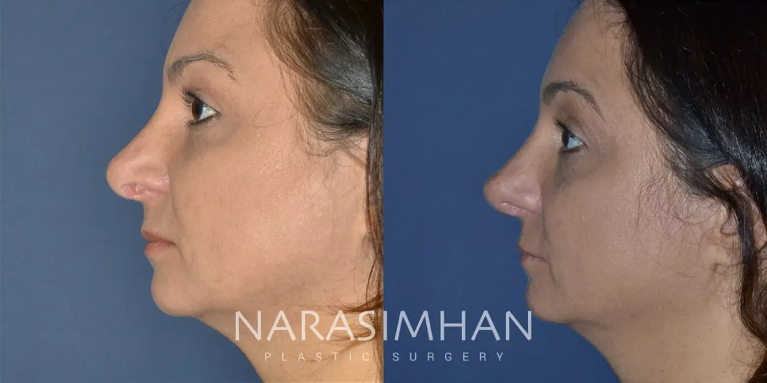 Facial Sculpting Before & After
