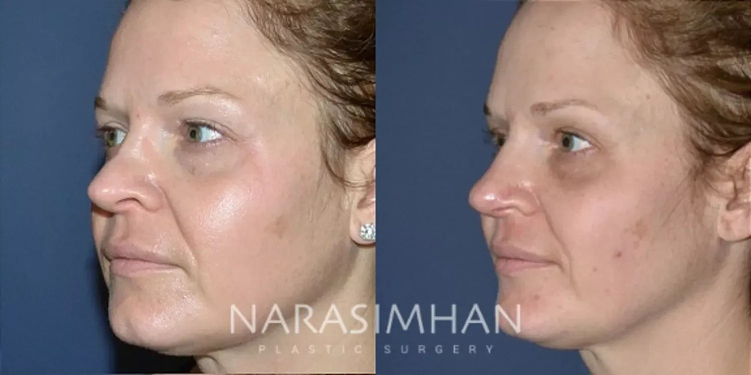 Facial Sculpting Before & After