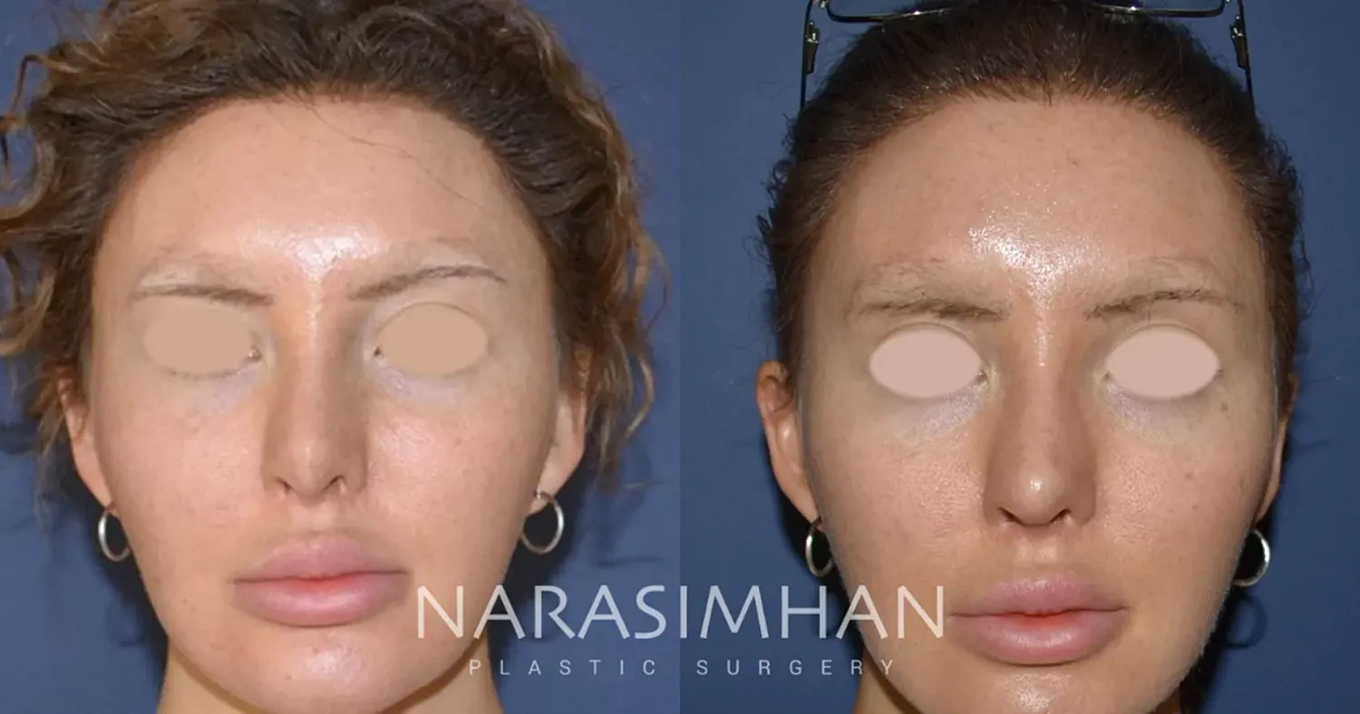 Facial Sculpting Before & After