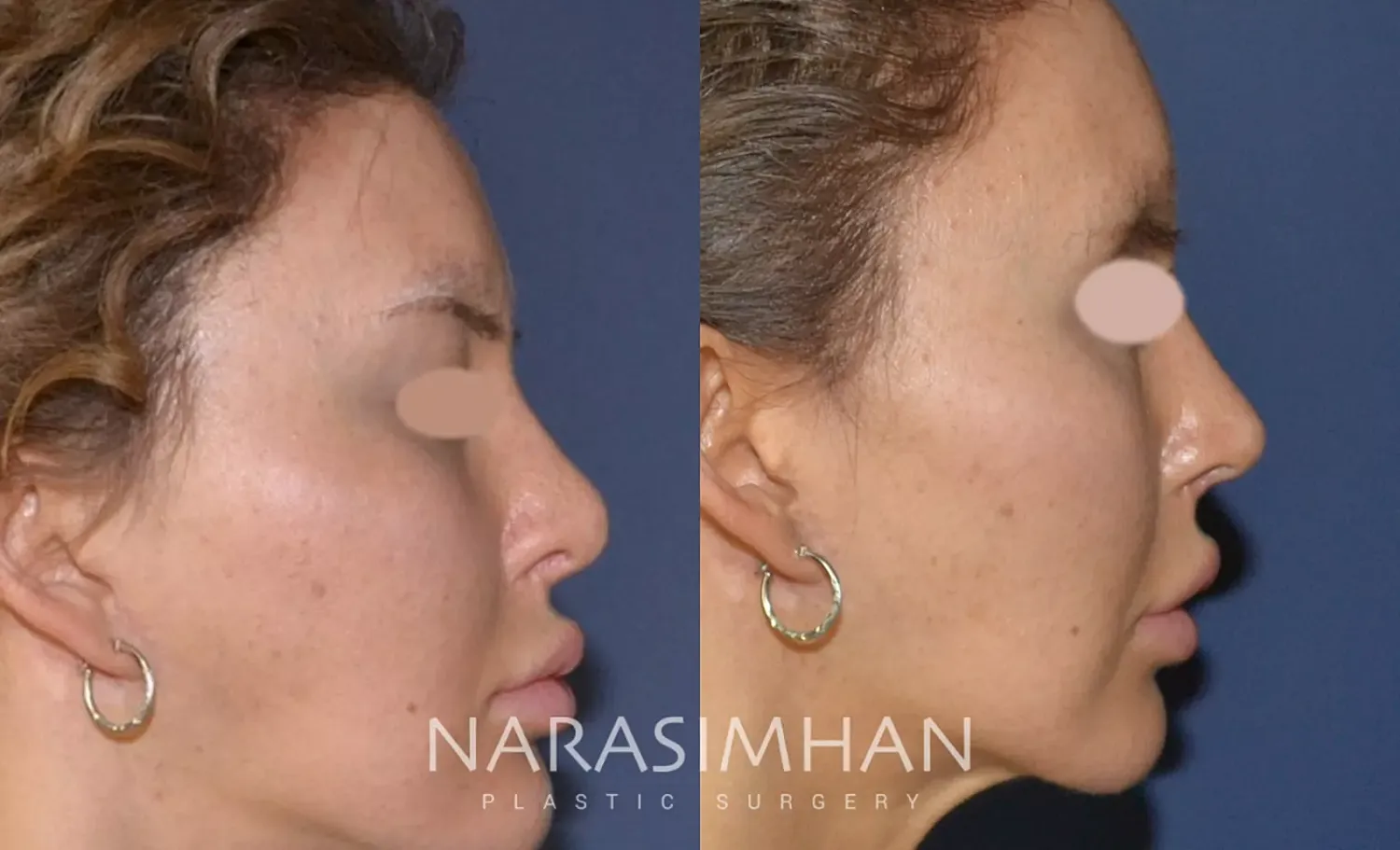 Facial Sculpting Before & After