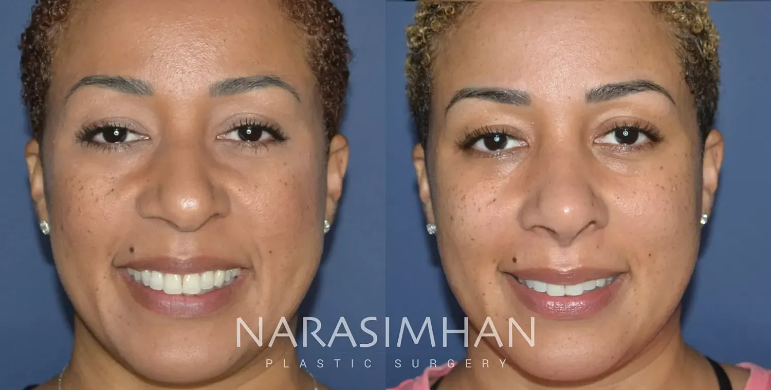 Facial Sculpting Before & After