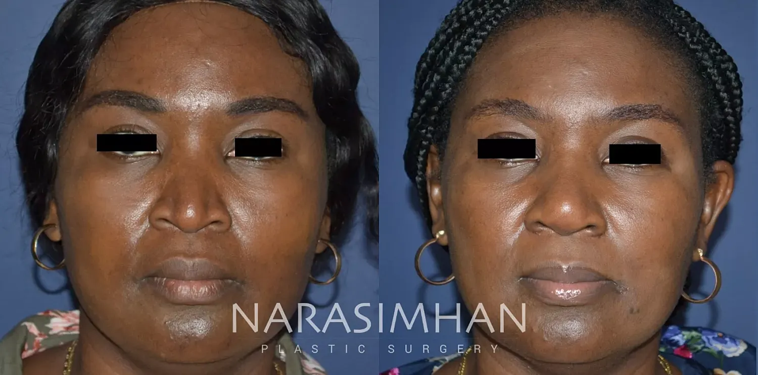 Facial Sculpting Before & After
