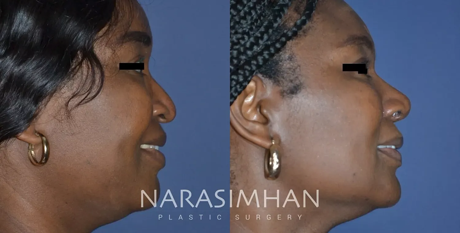 Facial Sculpting Before & After