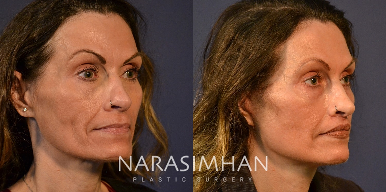 Facial Sculpting Before & After