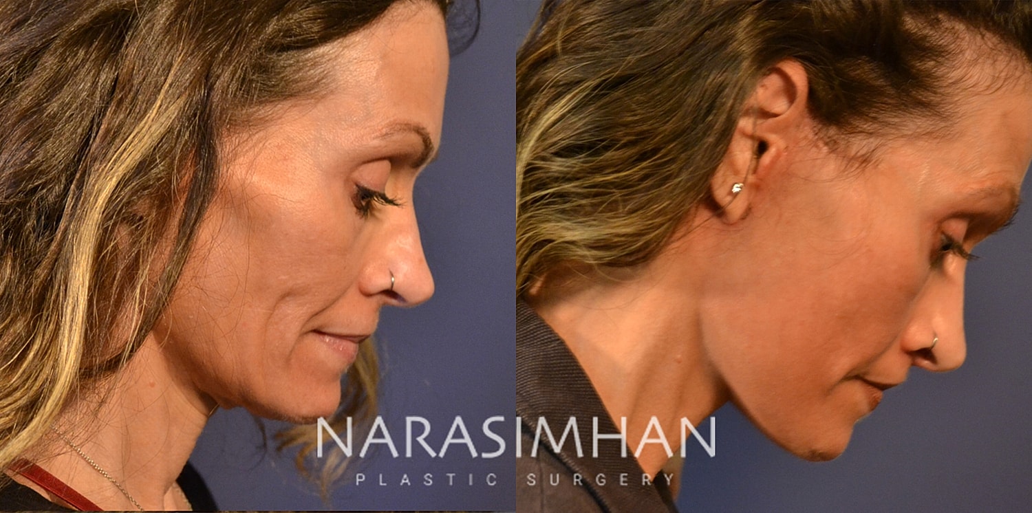 Facial Sculpting Before & After