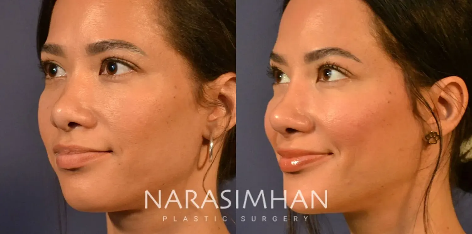 Facial Sculpting Before & After