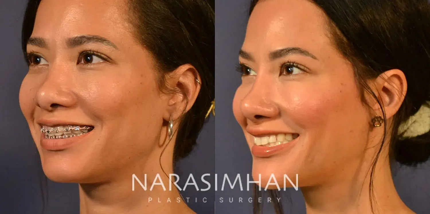 Facial Sculpting Before & After