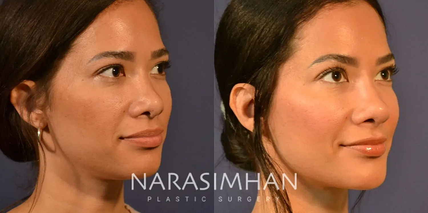 Facial Sculpting Before & After