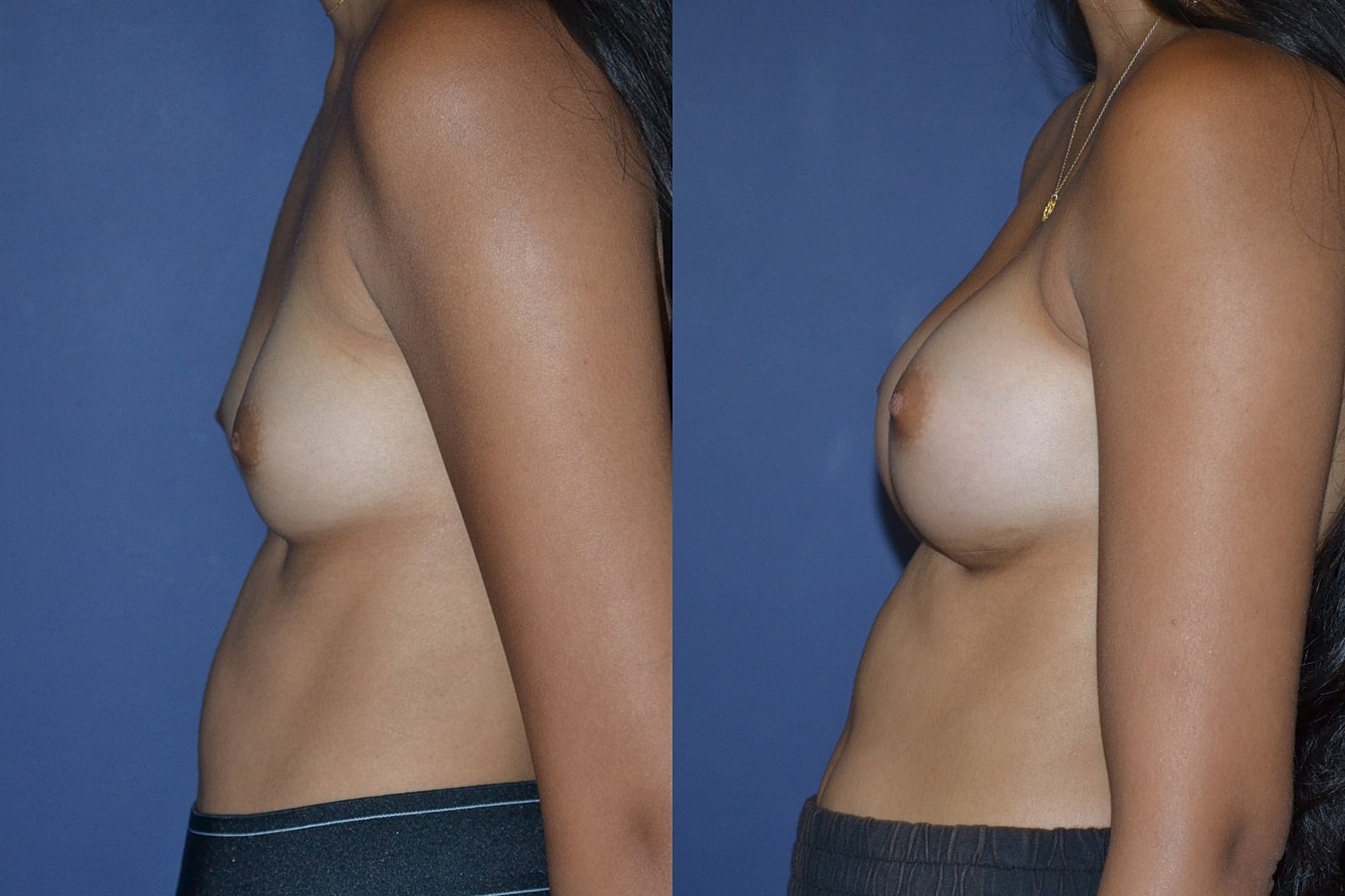 Breast Augmentation Before & After