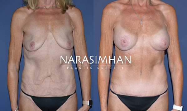 Breast Augmentation Before & After