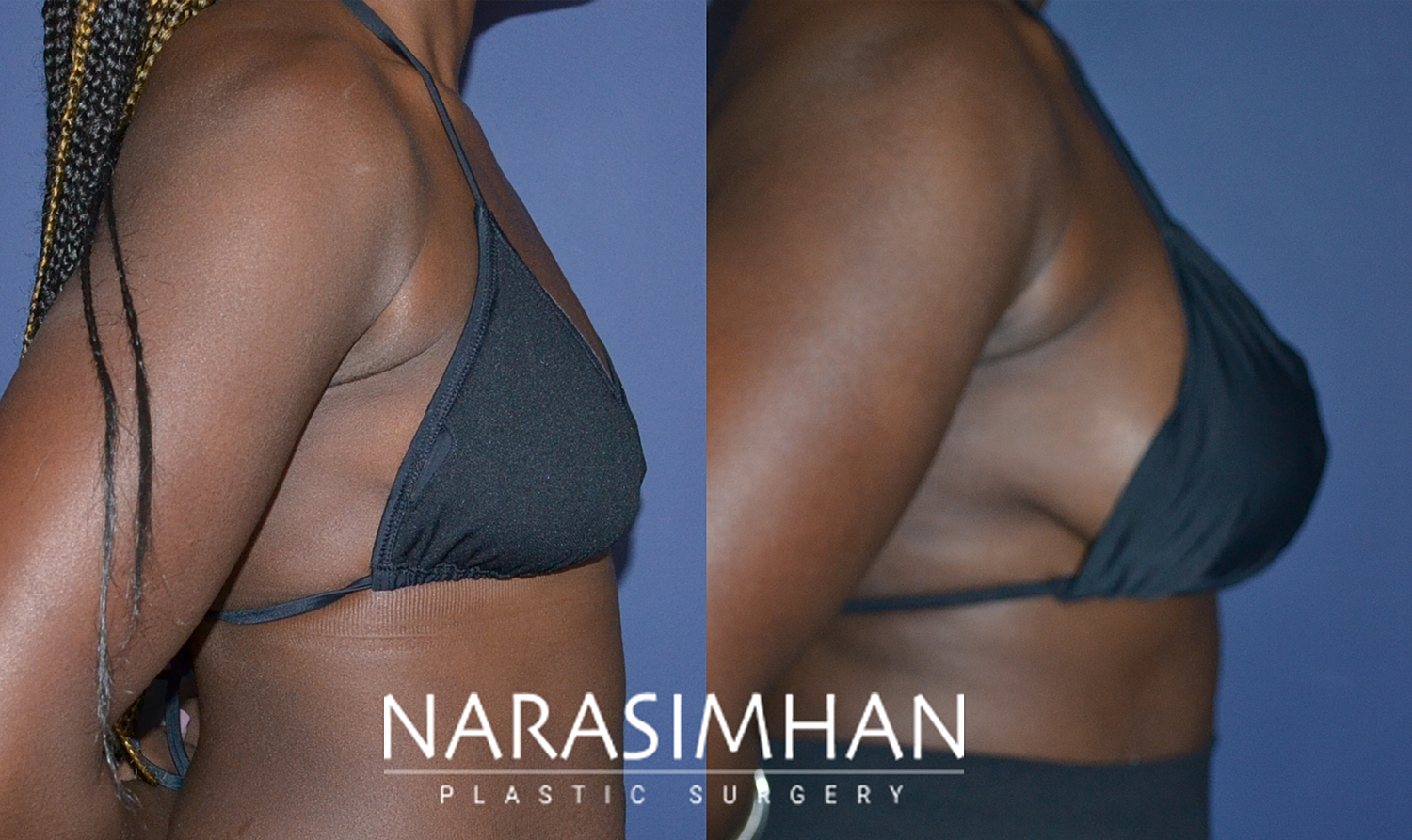 Breast Augmentation Before & After