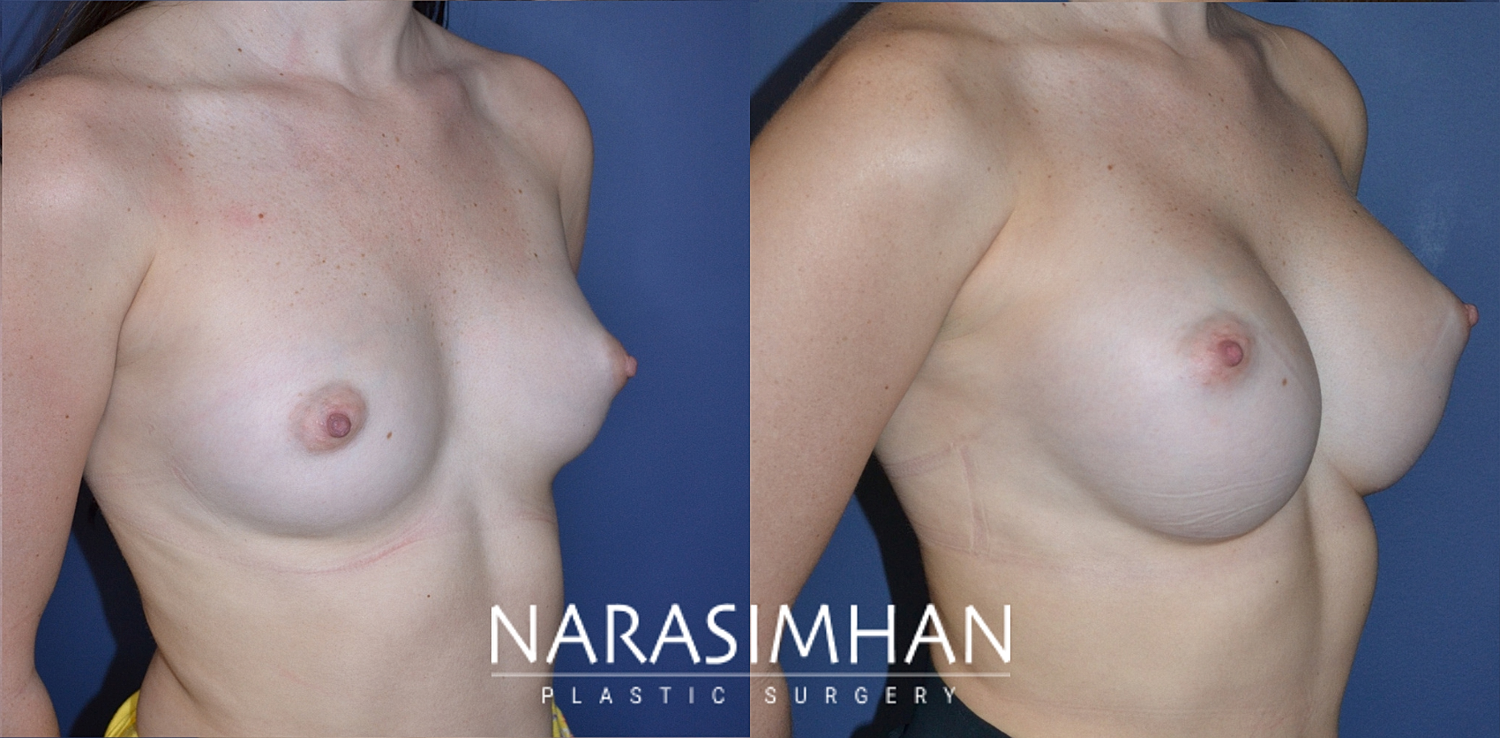 Breast Augmentation Before & After