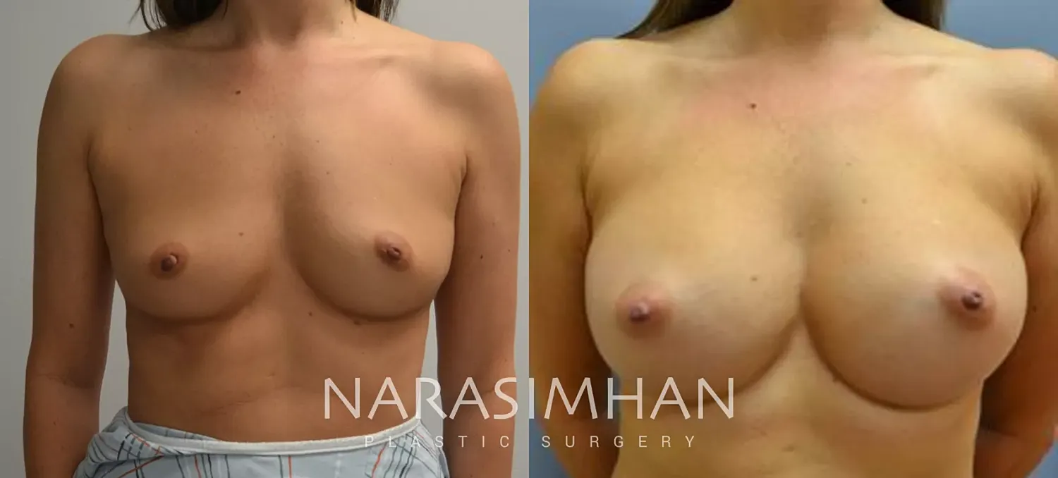 Breast Augmentation Before & After