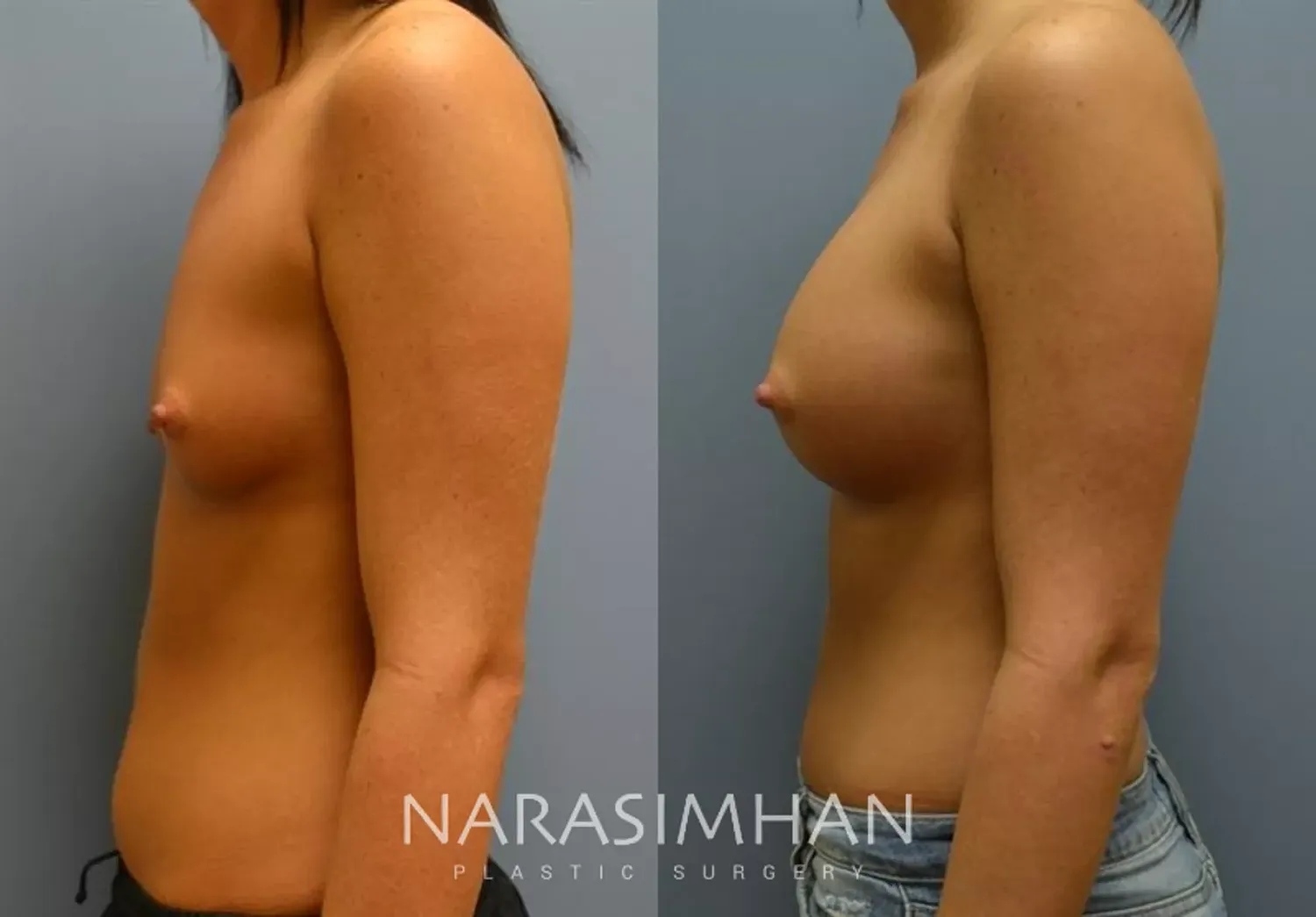 Breast Augmentation Before & After