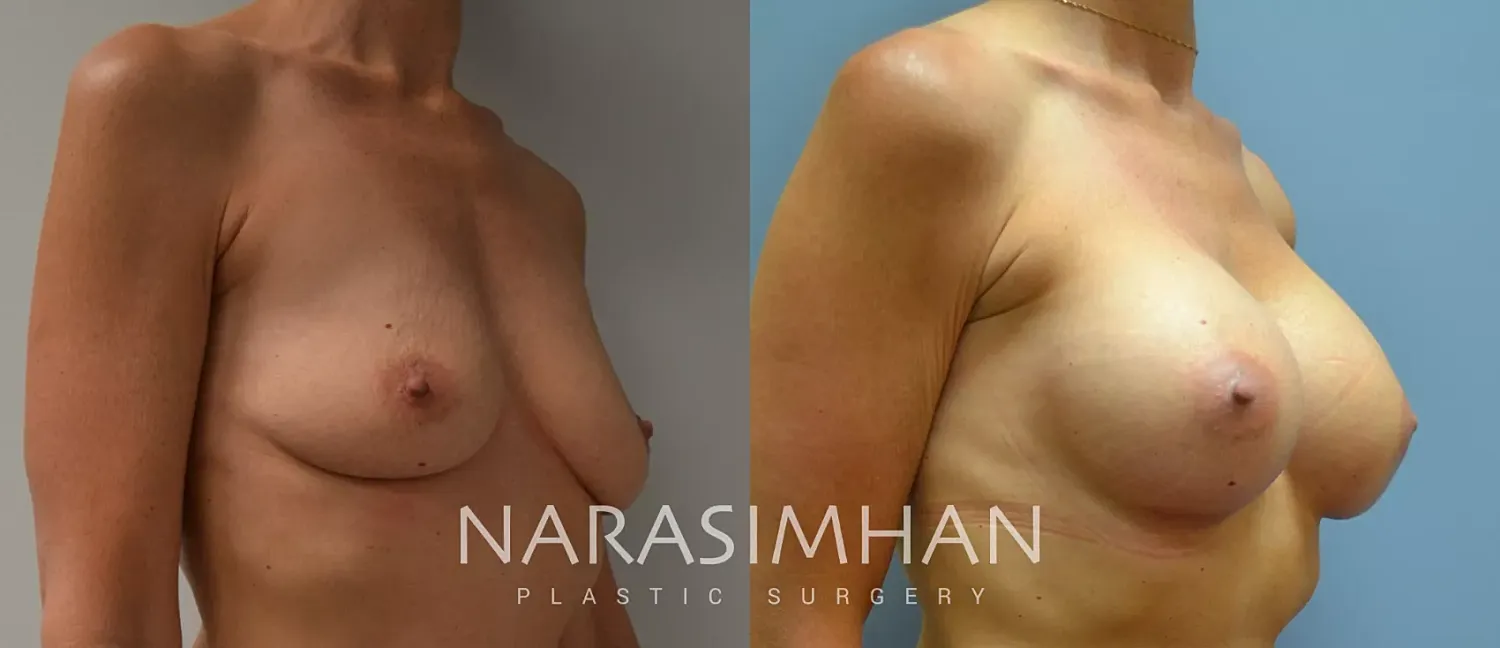 Breast Augmentation Before & After