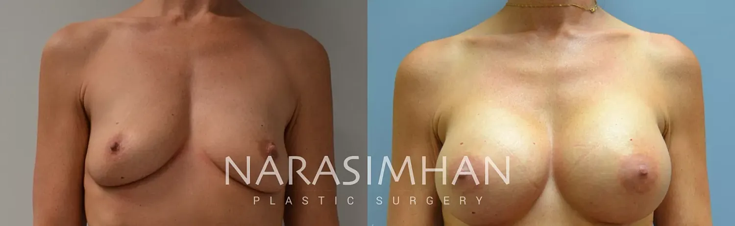 Breast Augmentation Before & After