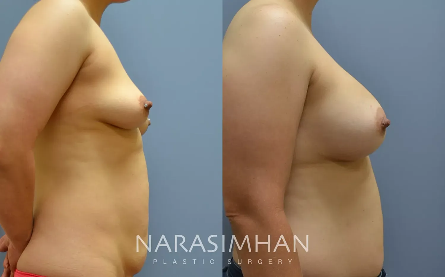 Breast Augmentation Before & After