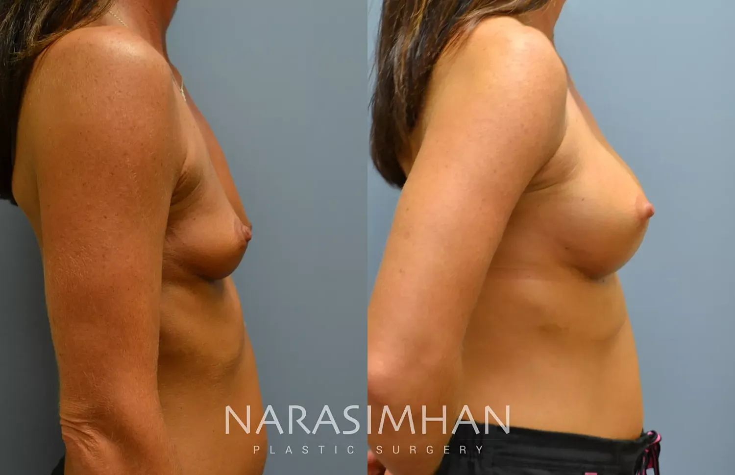 Breast Augmentation Before & After
