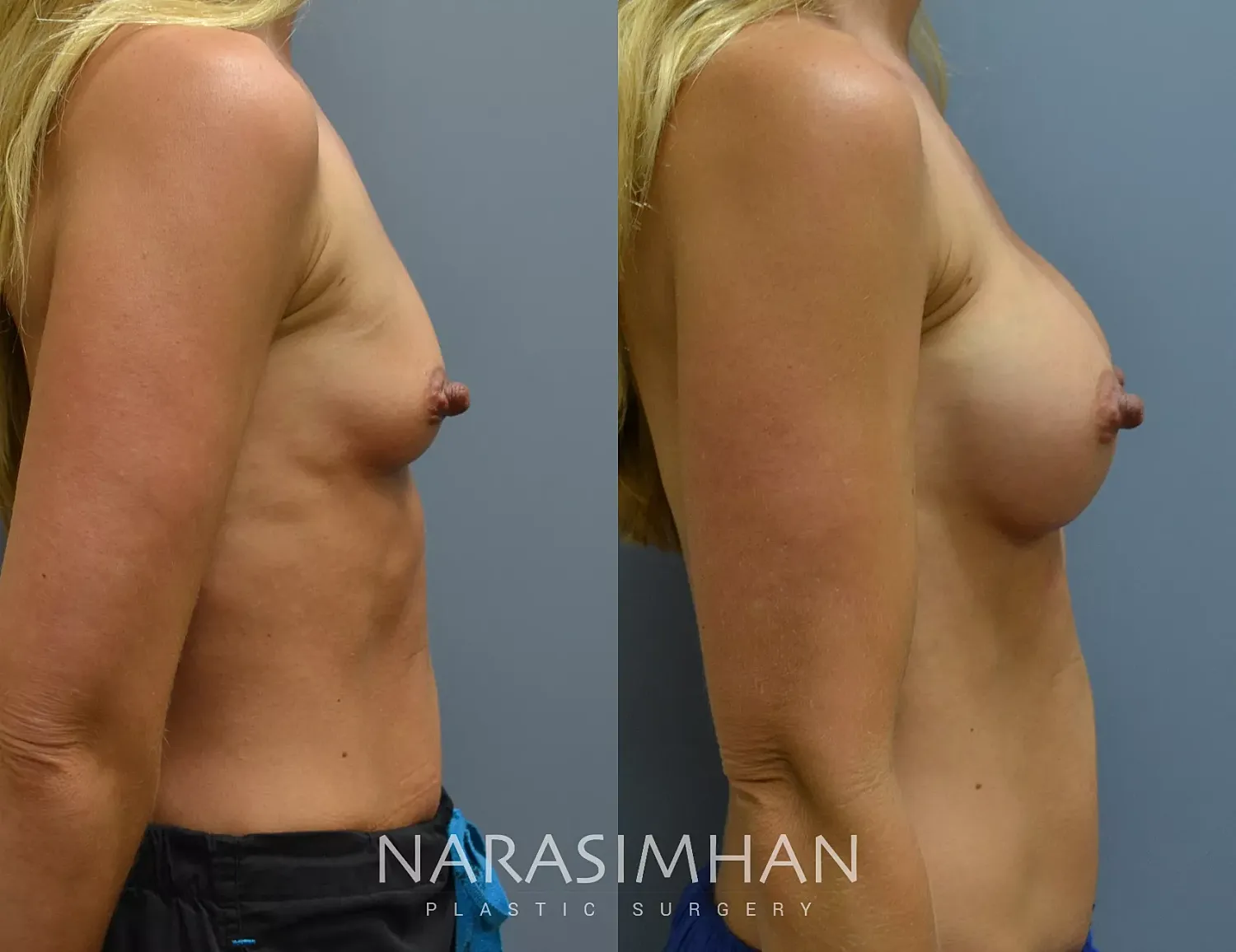 Breast Augmentation Before & After