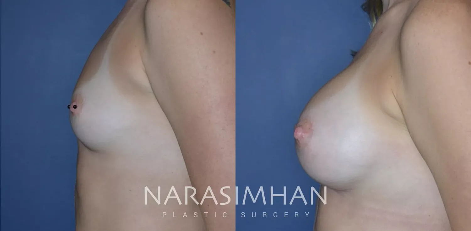 Breast Augmentation Before & After