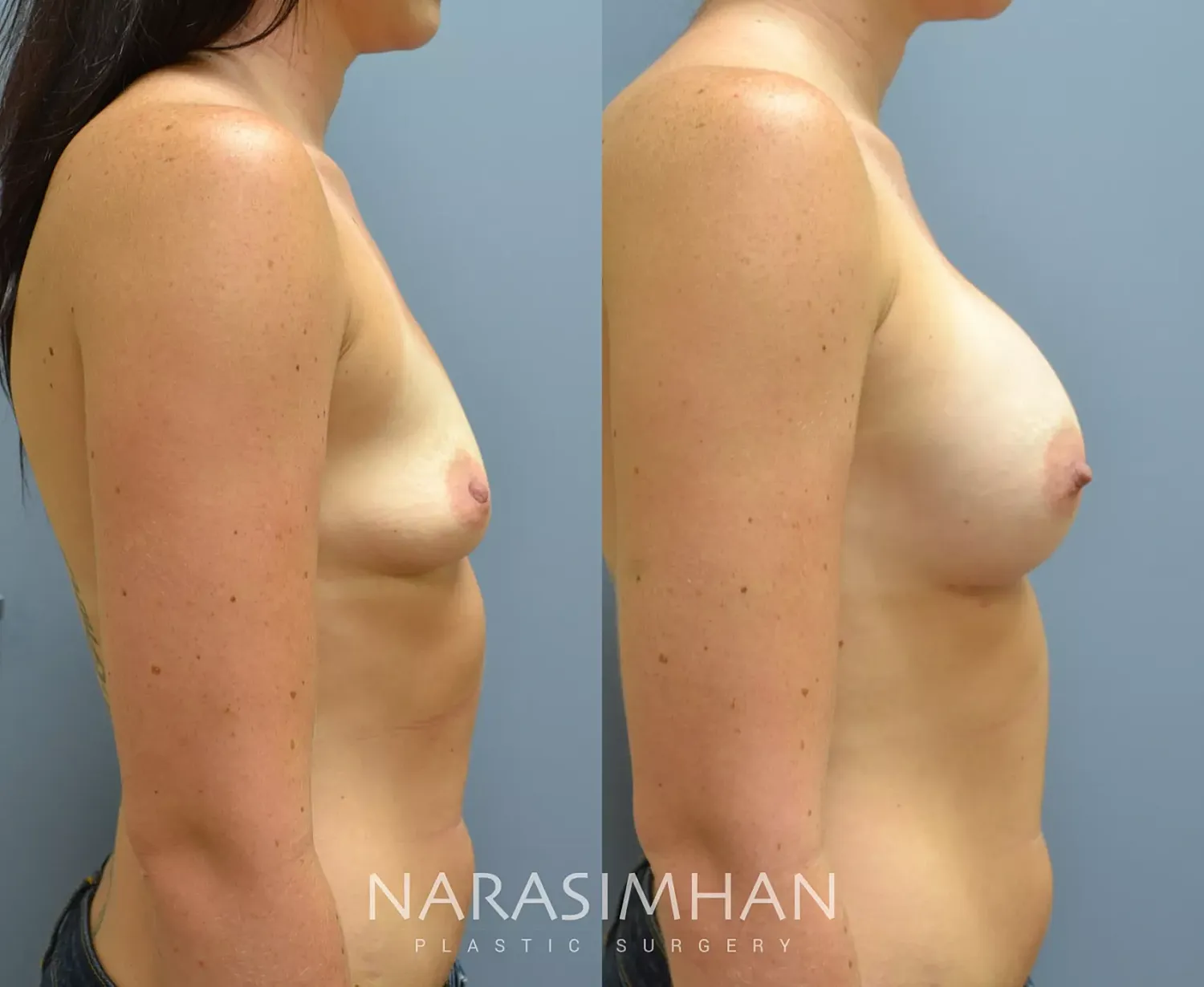 Breast Augmentation Before & After
