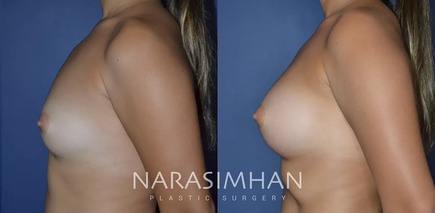 Breast Augmentation Before & After