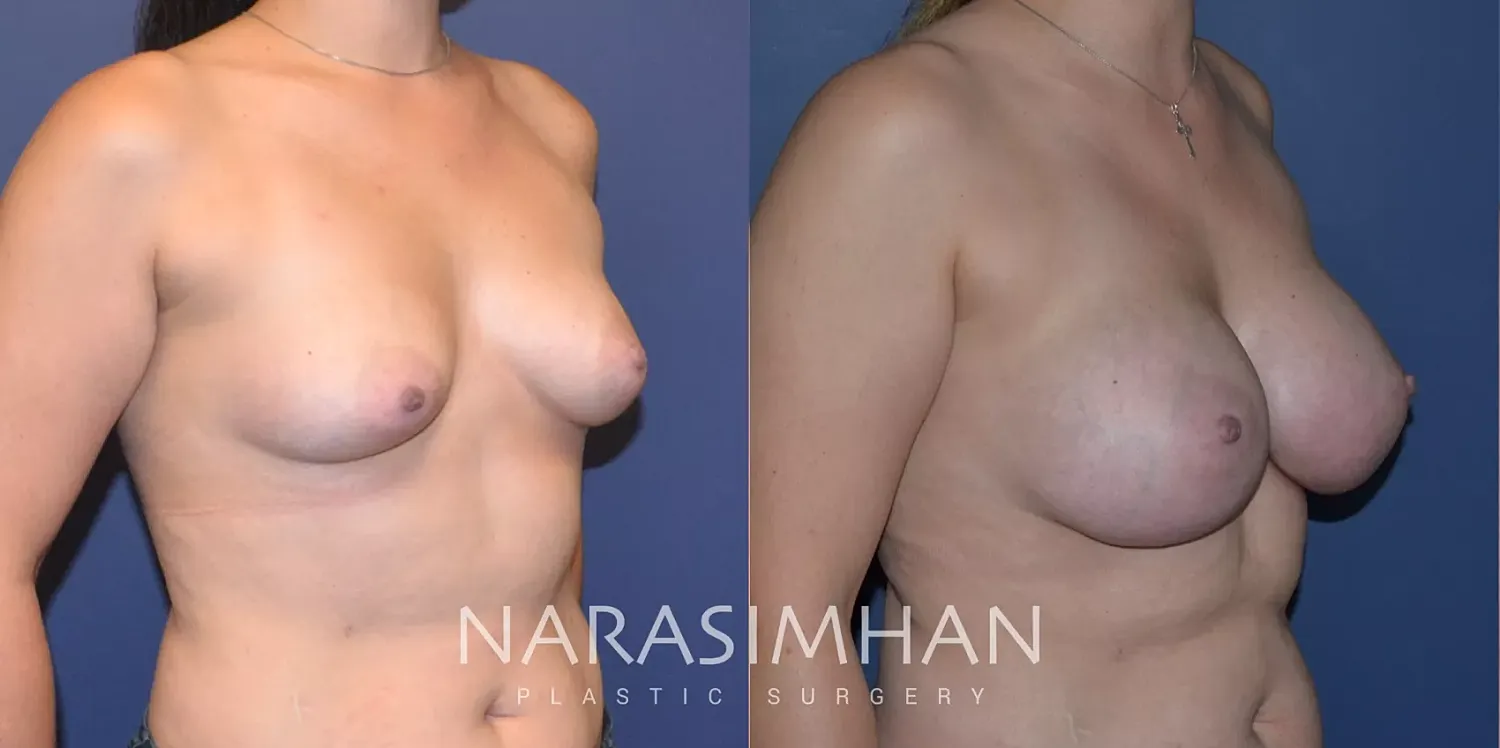 Breast Augmentation Before & After