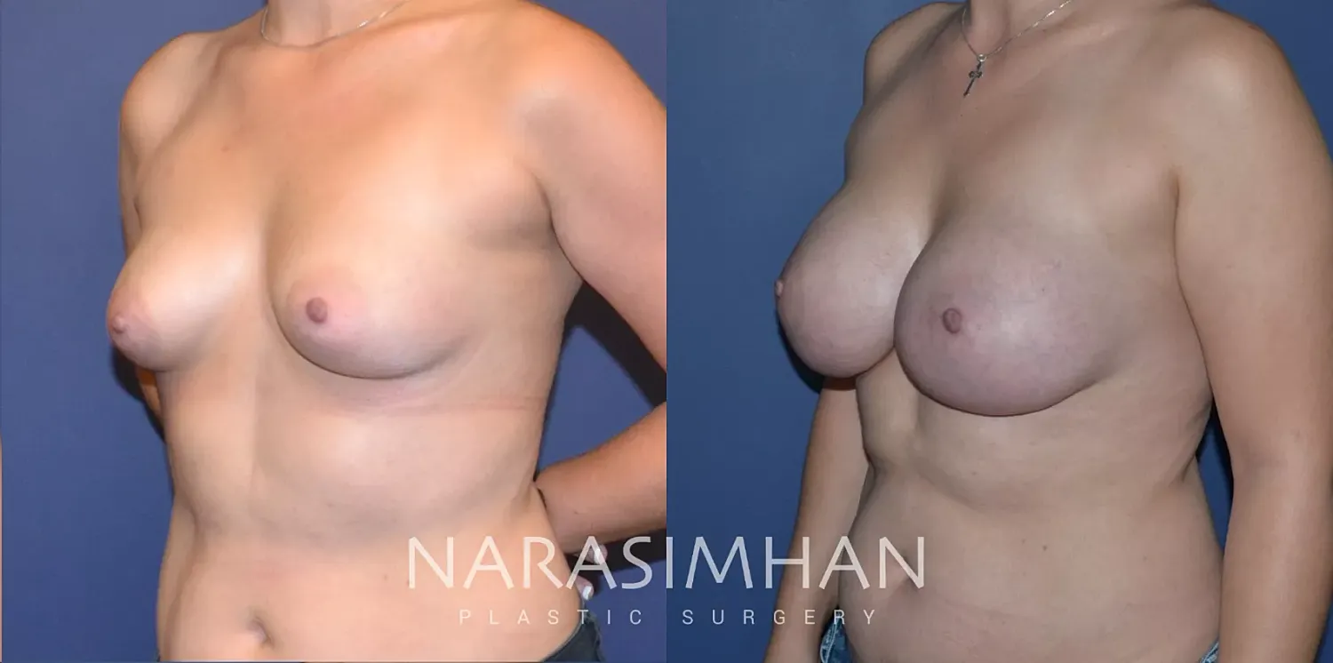 Breast Augmentation Before & After