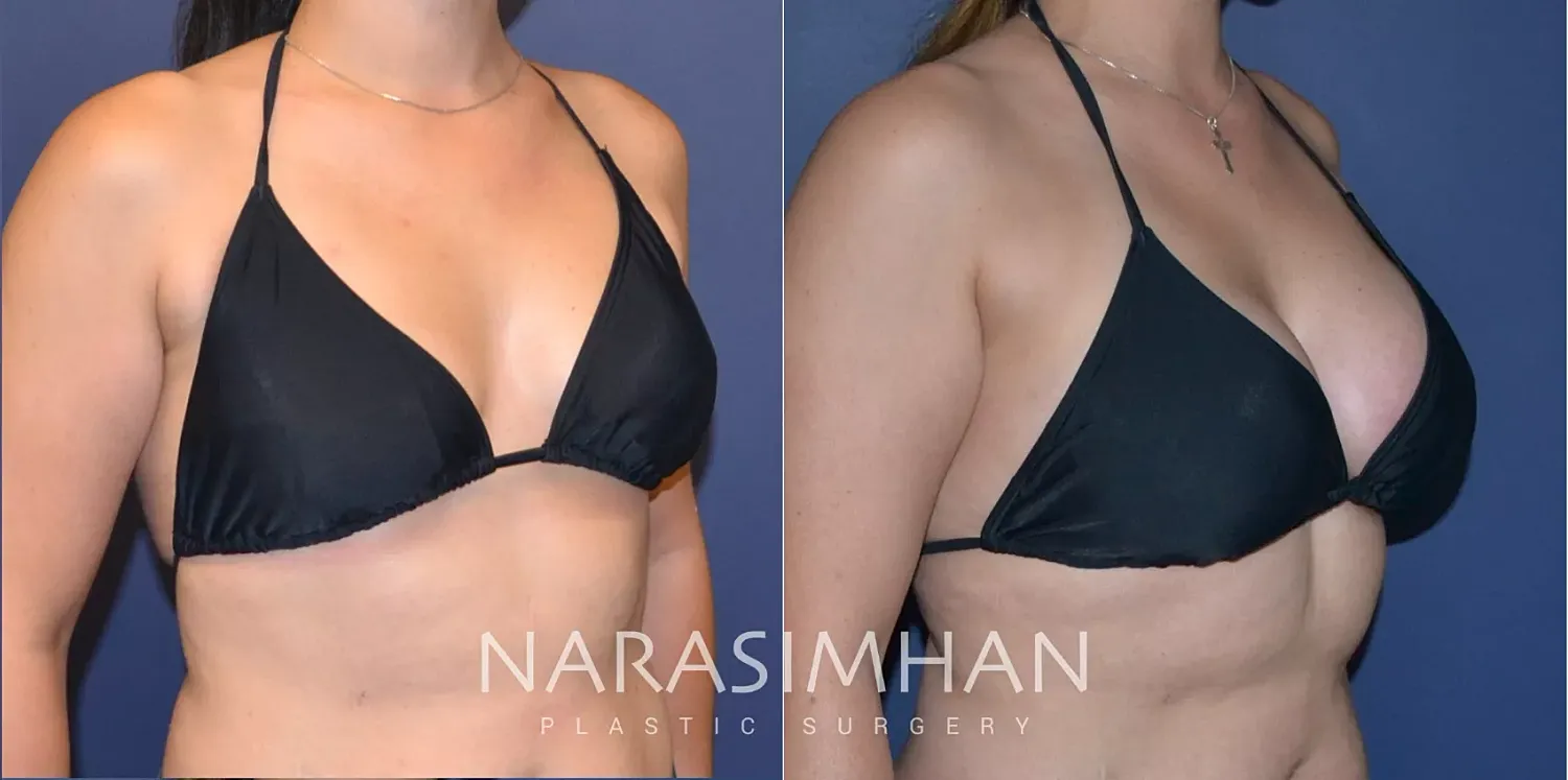 Breast Augmentation Before & After