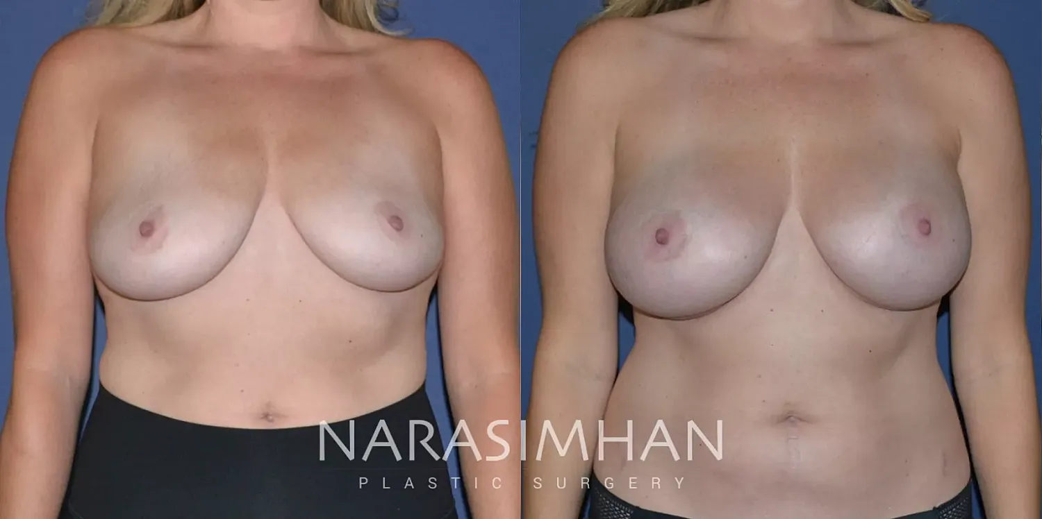 Breast Augmentation Before & After
